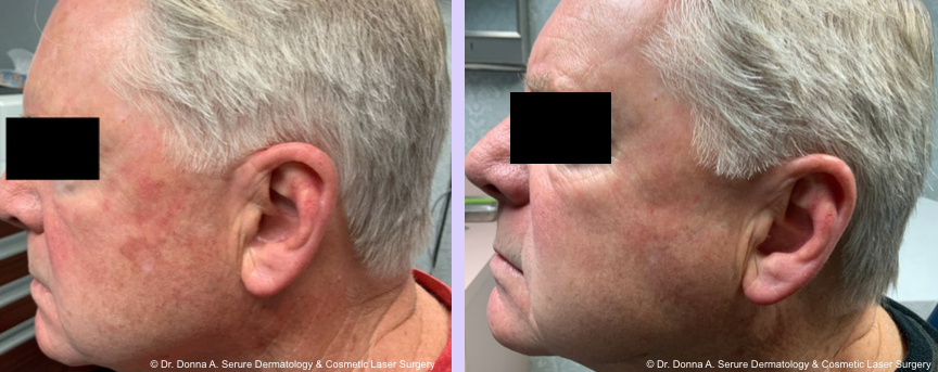 Before and After PDT ( photo dynamic therapy )